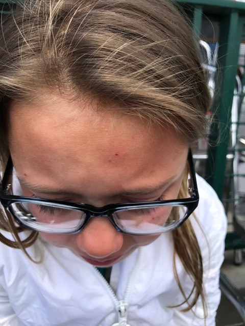 dagny-bee-sting-2-17